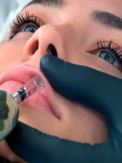 relleno hyaluron pen labios bilbao